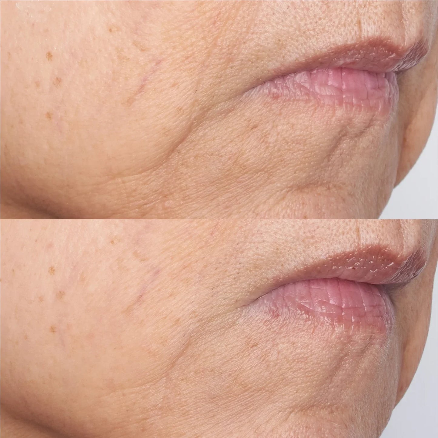 Cold Plasma + The Intensive Gel Mask